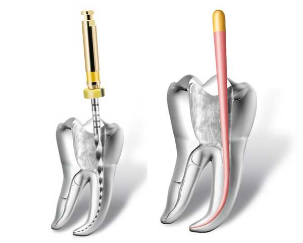 ENDODONTICS